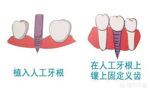 种植牙的优点与缺点是什么（种牙外提升优缺点）